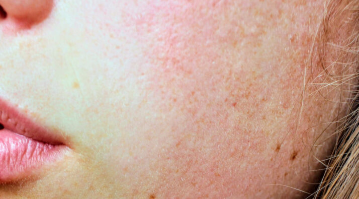 dermatitis pni clínica