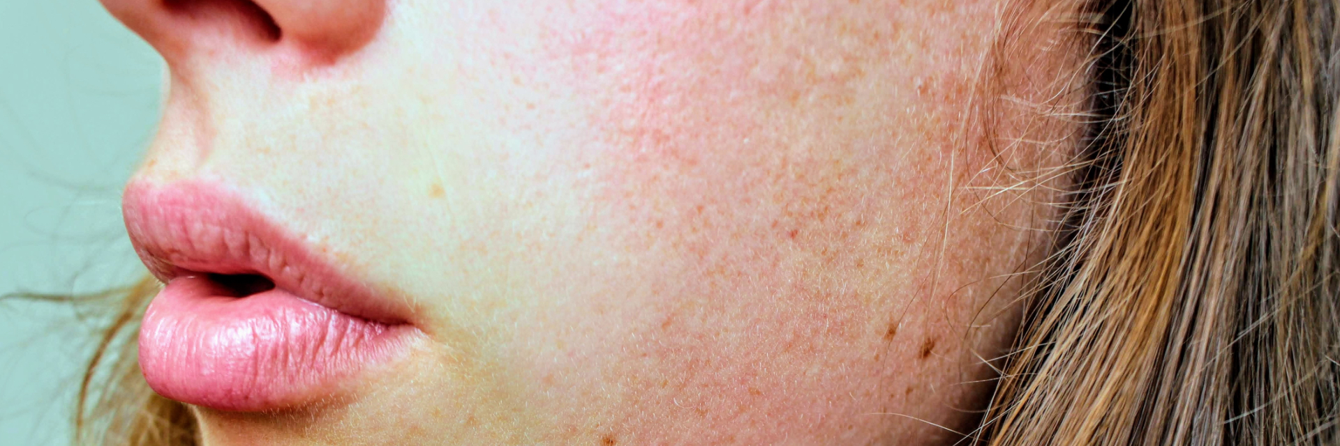  Dermatitis atópica: su conexión con el estrés y el sistema inmune. 