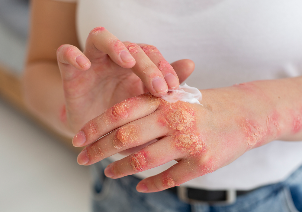 psoriasis pni