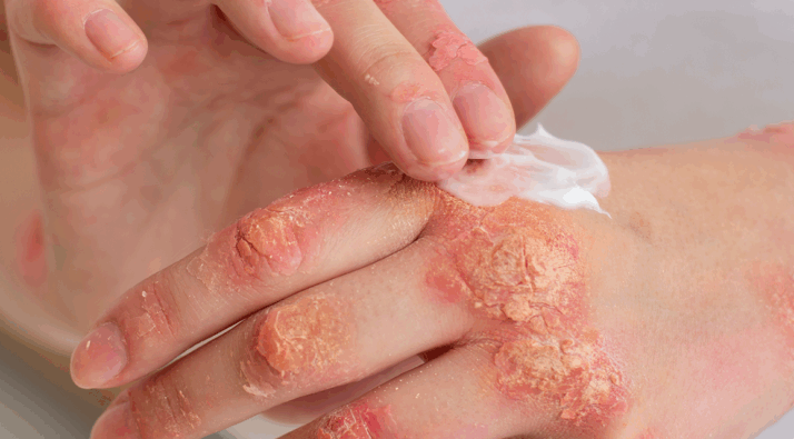 psoriasis pni