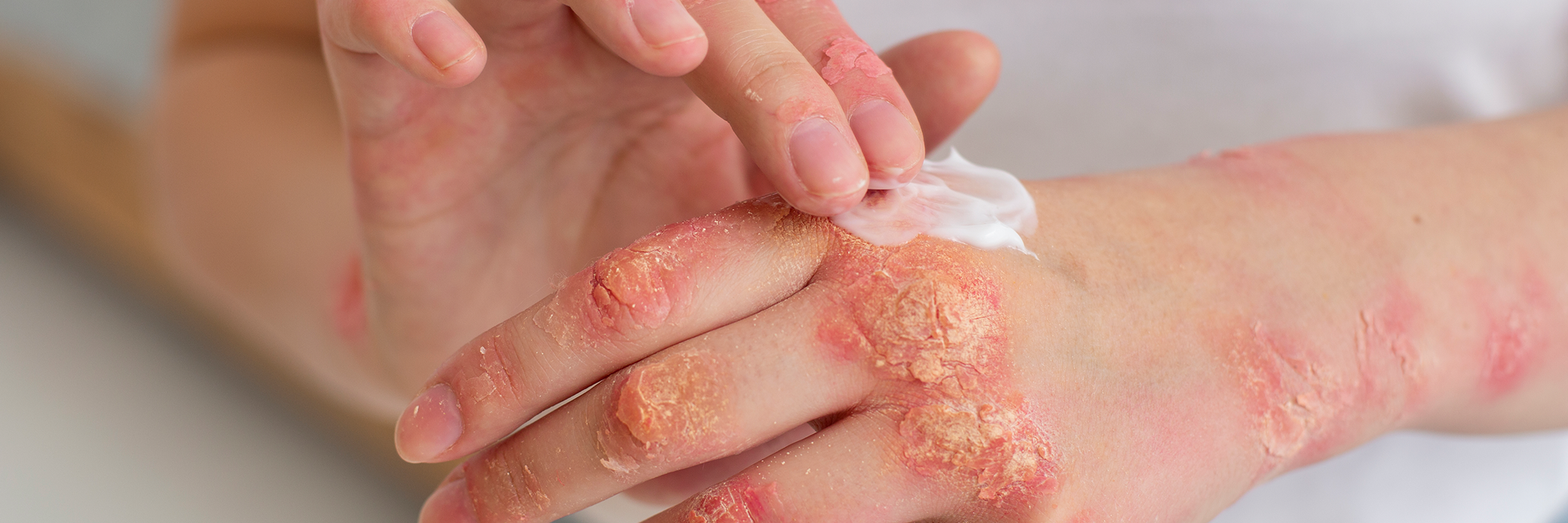 Psoriasis e intestino, abordaje desde la PNI clínica