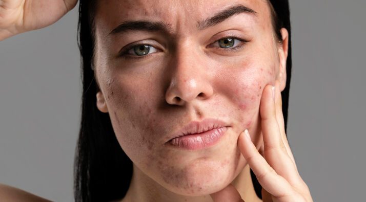 acne pni