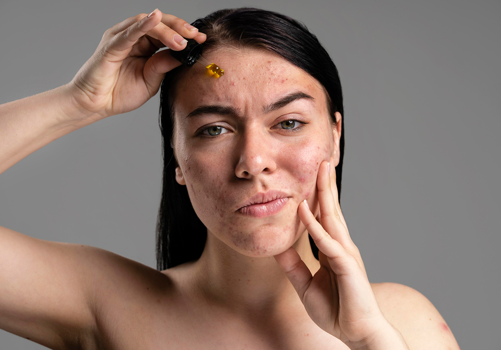 acne pni