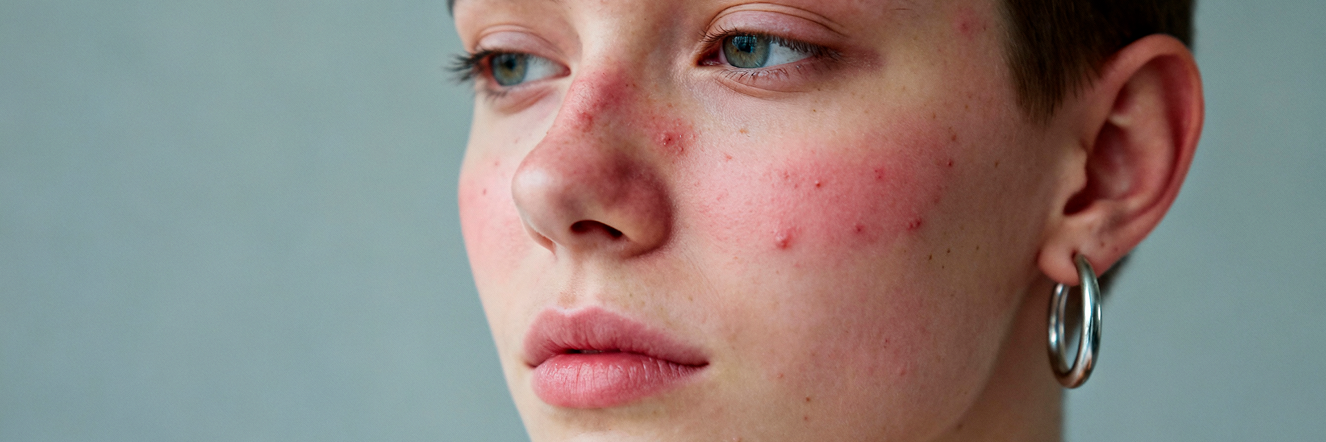 Lupus eritematoso sistémico (LES) desde la PNI clínica ¿Por qué los protocolos estándar no son suficientes?