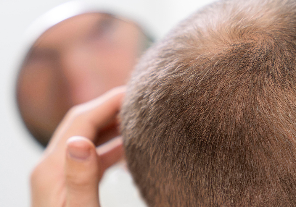 caída del pelo pni